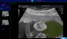 La startup Deepecho révolutionne le diagnostic pré-natal grâce à l'intelligence artificielle